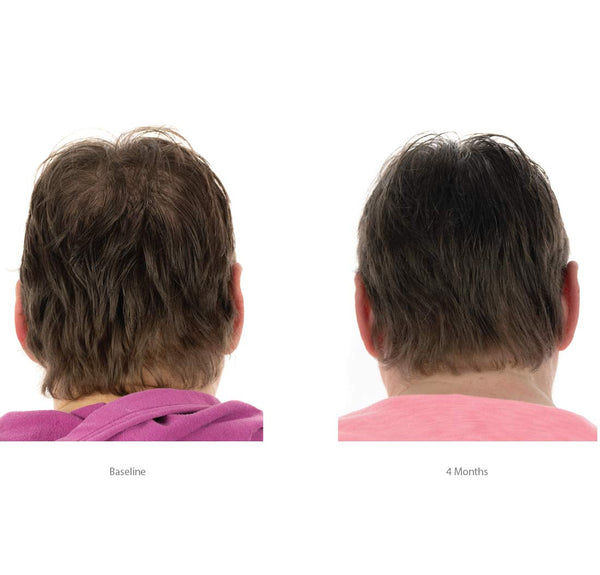 FOLIGAIN Women's Hair Regrowth Kit - FOLIGAIN
